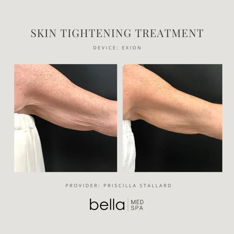 Skin Tightening Treatments in Clarksville, TN at Bella Medical Spa