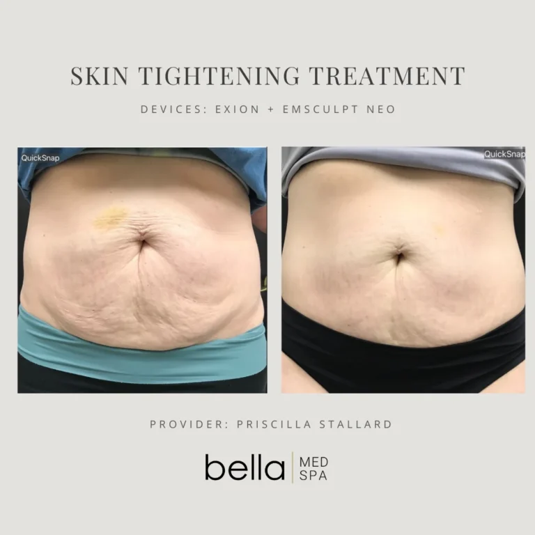 Skin Tightening Treatments in Clarksville, TN at Bella Medical Spa