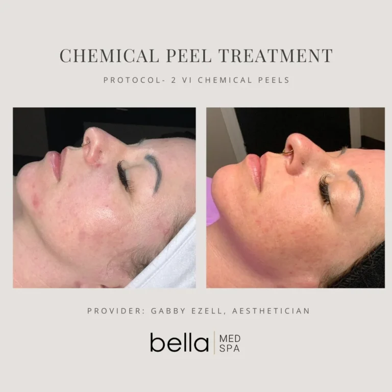 Chemical Peel Treatment Options