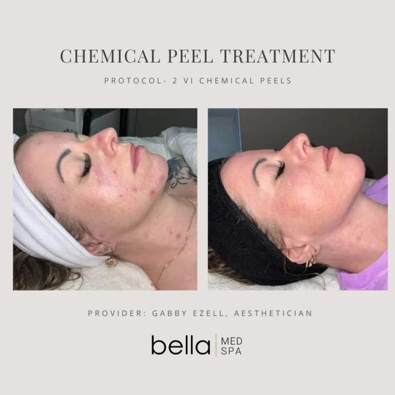 Chemical Peel Treatment Options