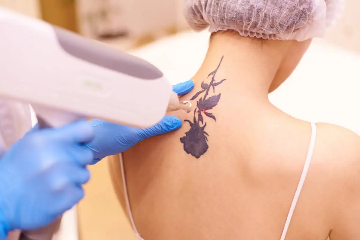 Tattoo Removal by Bella Medical Spa in CLARKSVILLE, TN