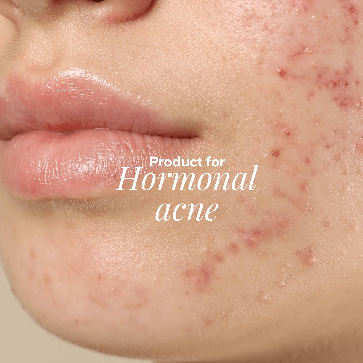 Topical Spironolactone Cream