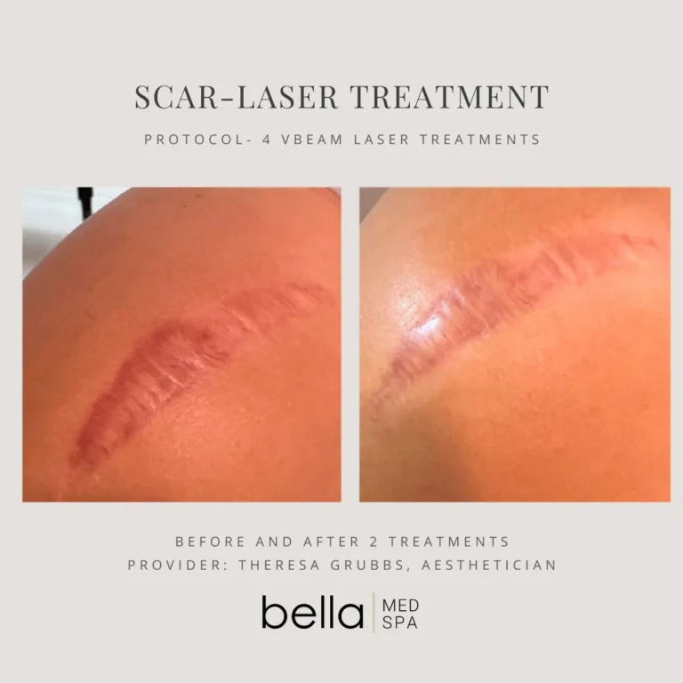 Laser Treatments in Clarksville, TN at Bella Medical Spa