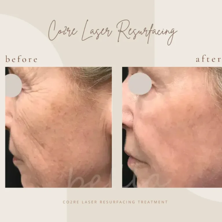 Laser Treatments in Clarksville, TN at Bella Medical Spa