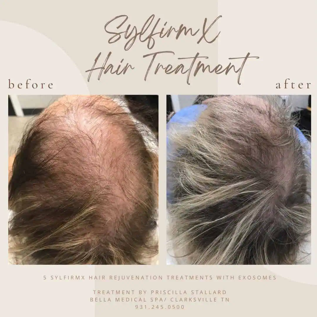 Before-And-After-Hair-Treatment-Clarksville-TN-Bella-Med-Spa-In Clarksville-TN