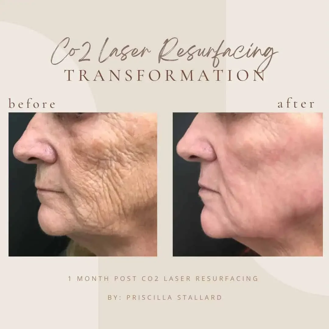 CO2 Laser Resurfacing at Bella Med Spa