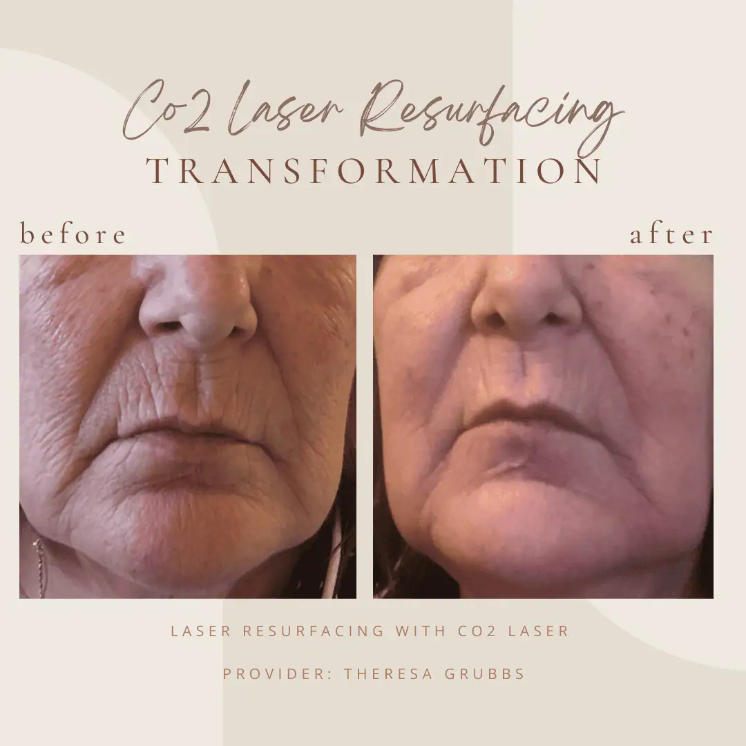 CO2 Laser Resurfacing at Bella Med Spa