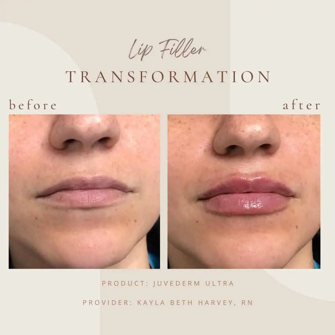 Cosmetic-Filler-BAin-Clarksville-Tn
