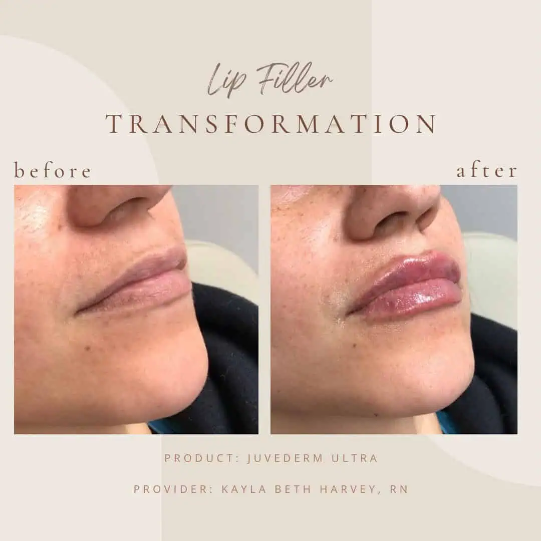 Cosmetic-Fillerin-Clarksville-Tn