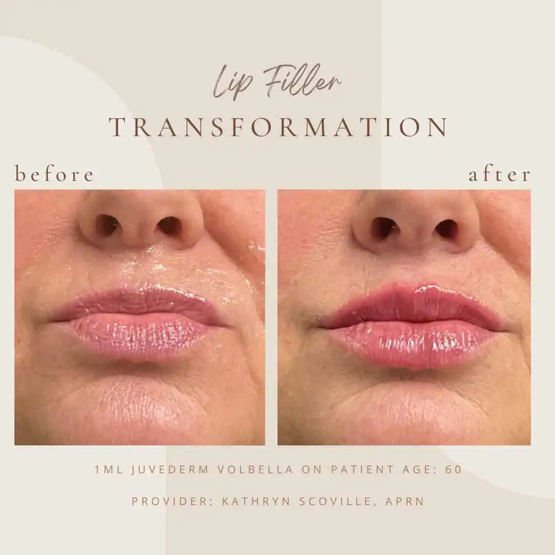 Dermal-Filler-BA-in-Clarksville-Tn