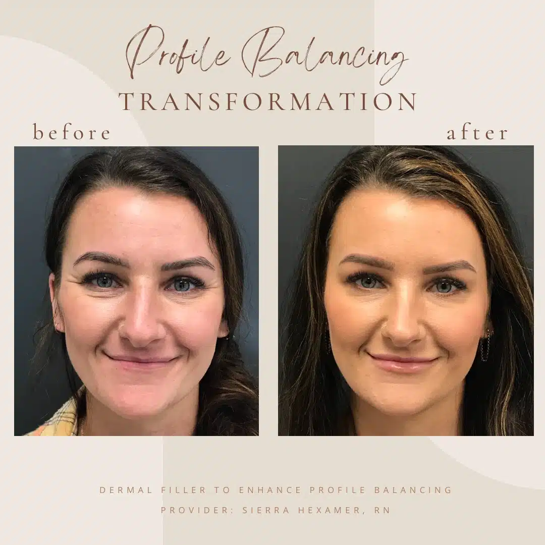 Dermal-Filler-Before-After