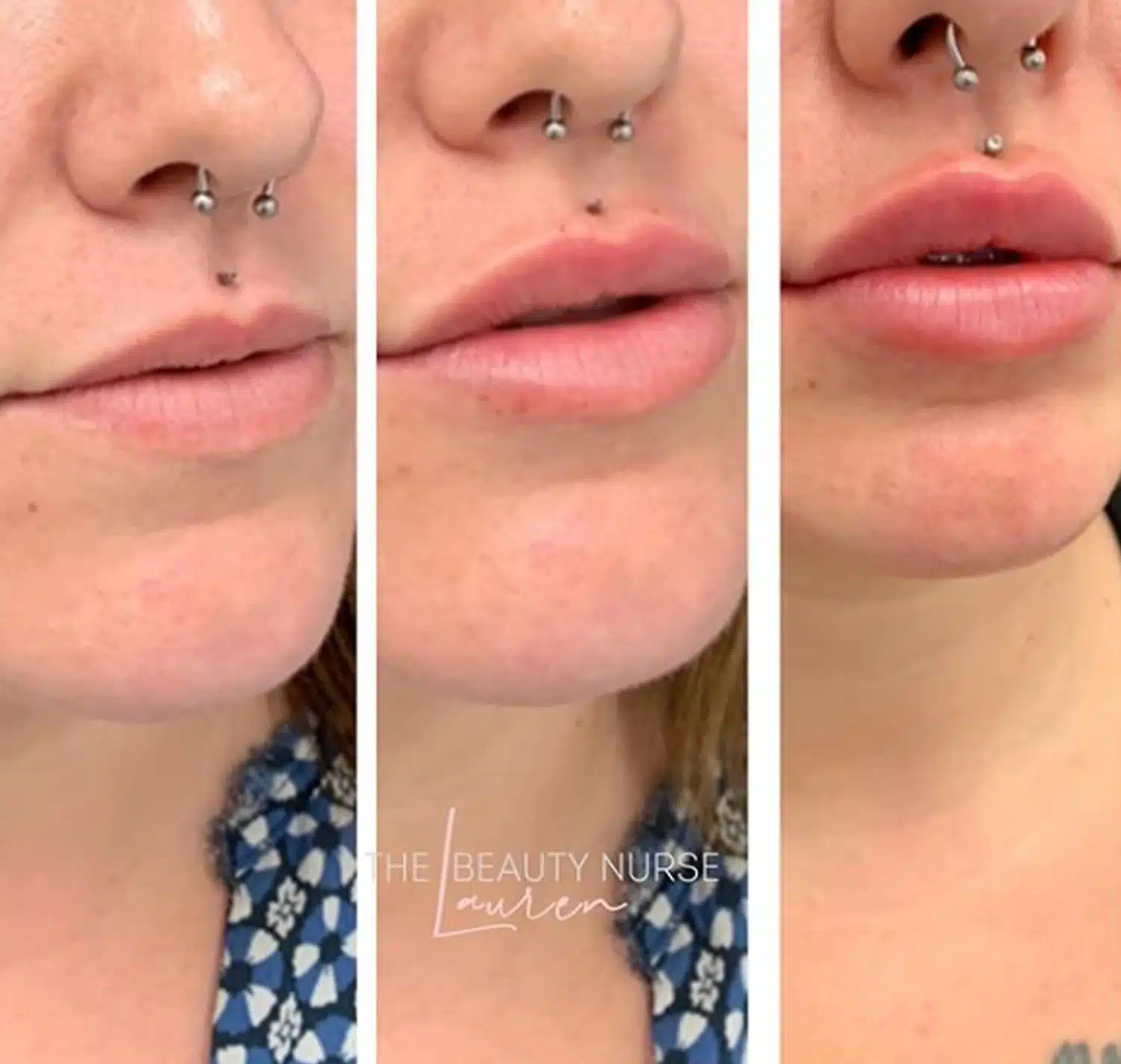 Lip Enhancement With Dermal Filler-in-Clarksville-Tn-five