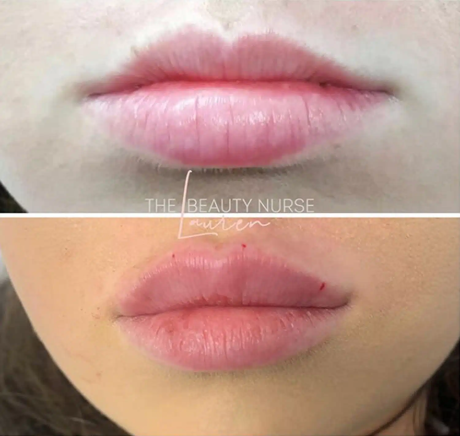 Lip Enhancement With Dermal Filler-in-Clarksville-Tn-four