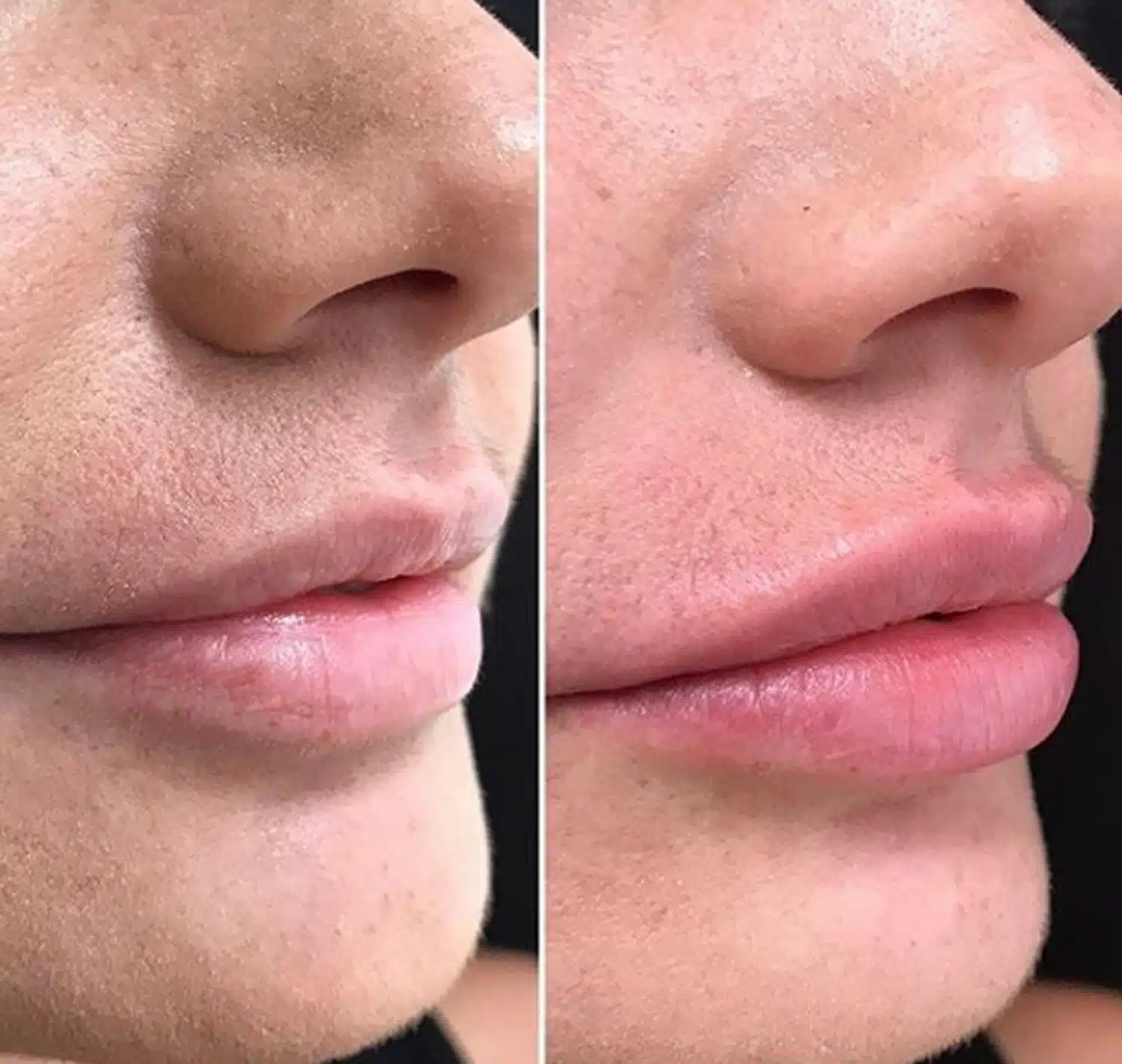 Lip Enhancement With Dermal Filler-in-Clarksville-Tn-six