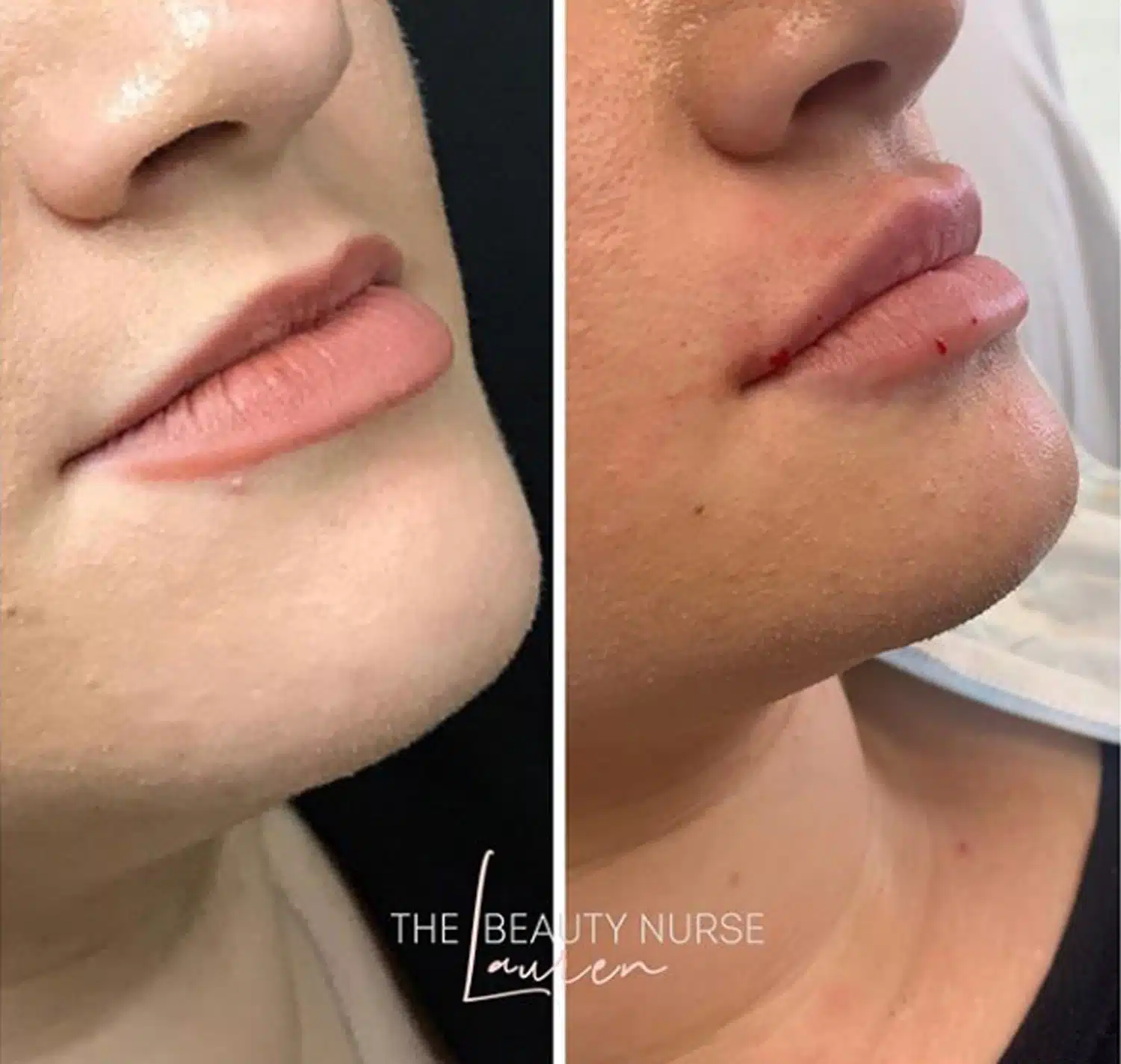 Lip Enhancement With Dermal Filler-in-Clarksville-Tn-three