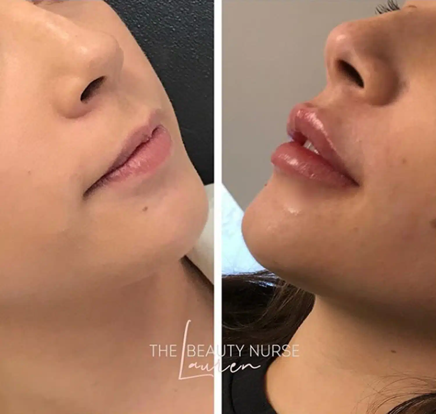 Lip Enhancement With Dermal Filler-in-Clarksville-Tn-two