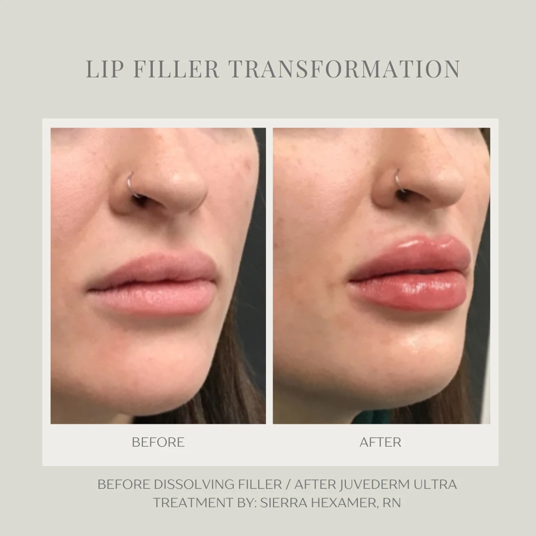Sculptra-Transformation-A--in-Clarksville-Tn