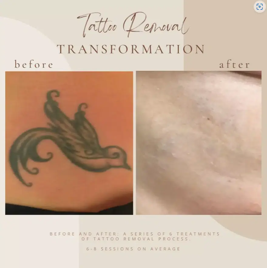 Tattoo Removal - Bella Med Spa In Clarksville TN