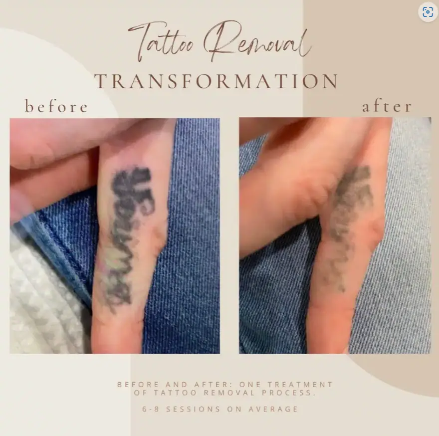 Tattoo Removal - Bella Med Spa In Clarksville TN