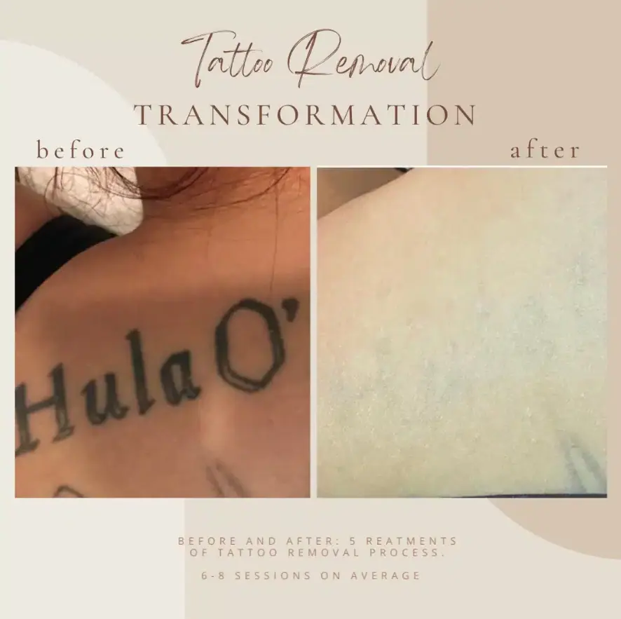 Tattoo Removal - Bella Med Spa In Clarksville TN
