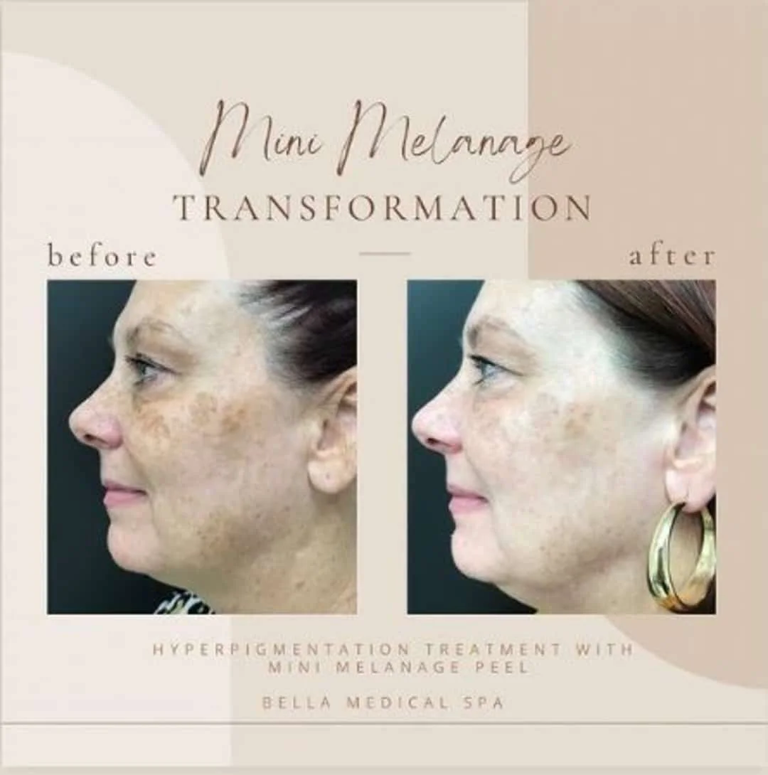 chemical-peel-before-and-after-In Clarksville-TN