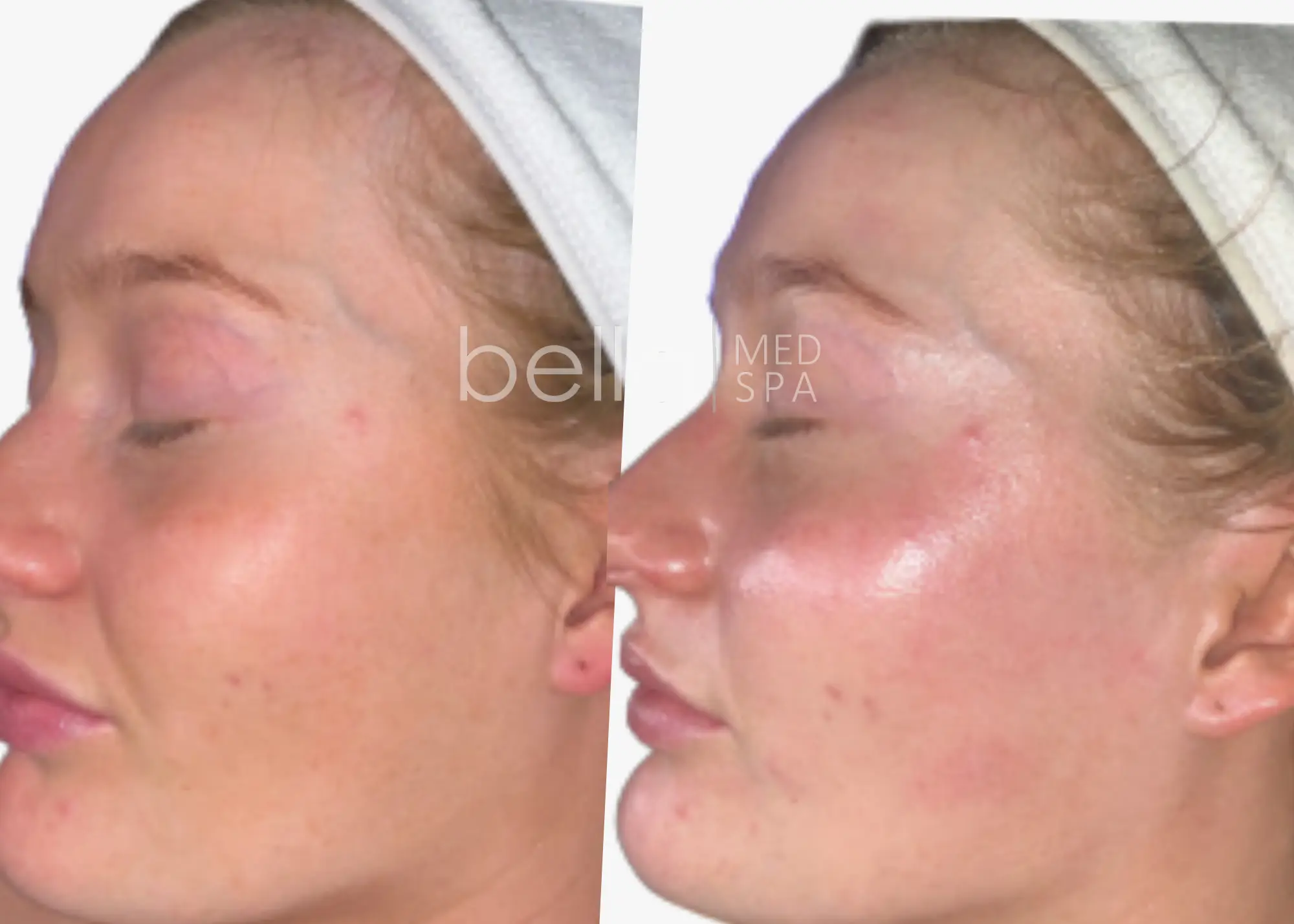 demaplan-candidate-by Bella-Medspa-in-Clarksville-TN
