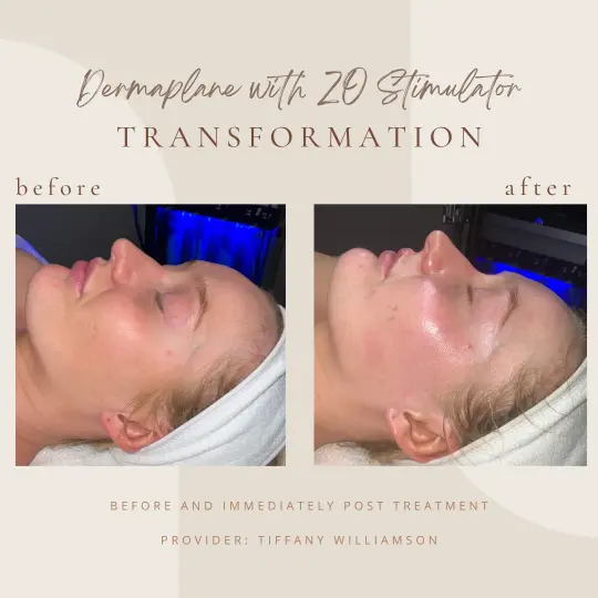 dermaplane-with-zoin-Clarksville-Tn-a--