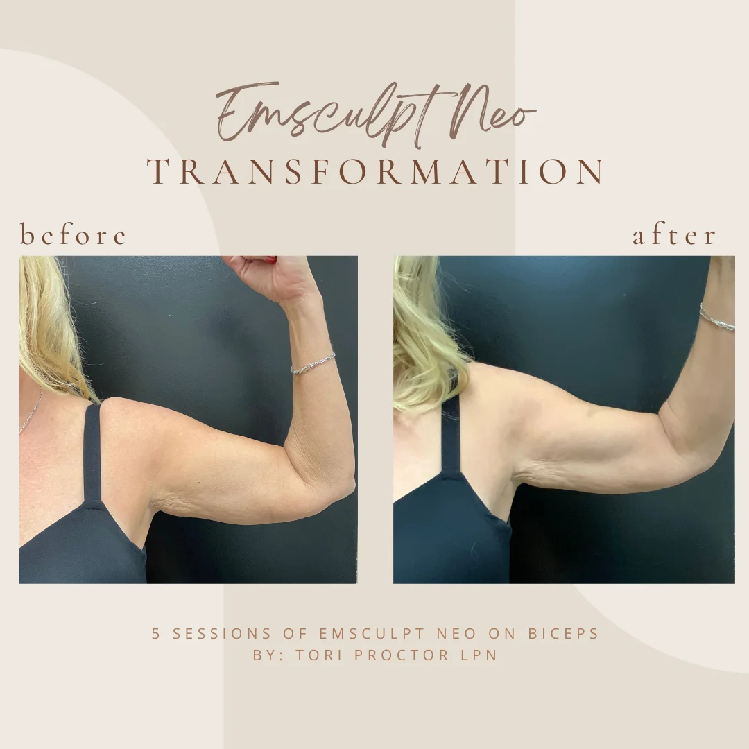 emsculpt-bicepsin-Clarksville-Tn