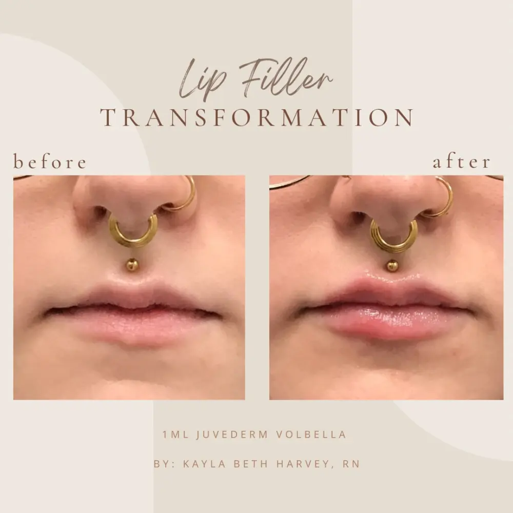 filler-KBin-Clarksville-Tn-a–