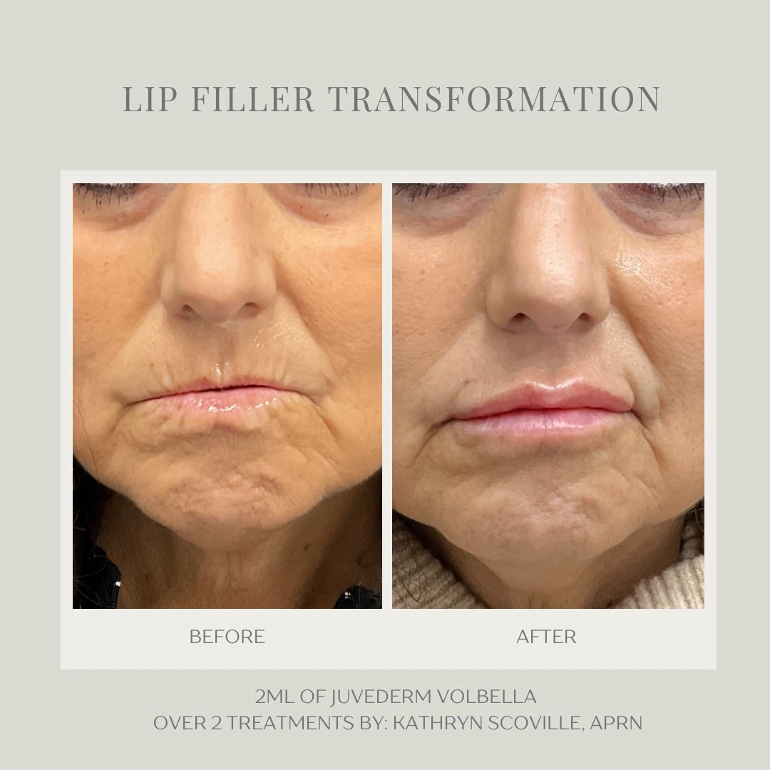 lip-filler-Z-in-Clarksville-Tn