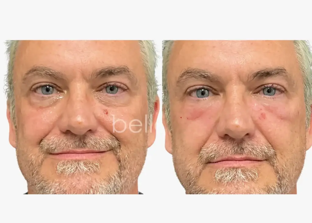 PRP Injections in Clarksville TN at Bella Med Spa