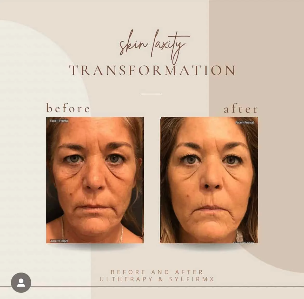 skin-laxityin-Clarksville-Tn