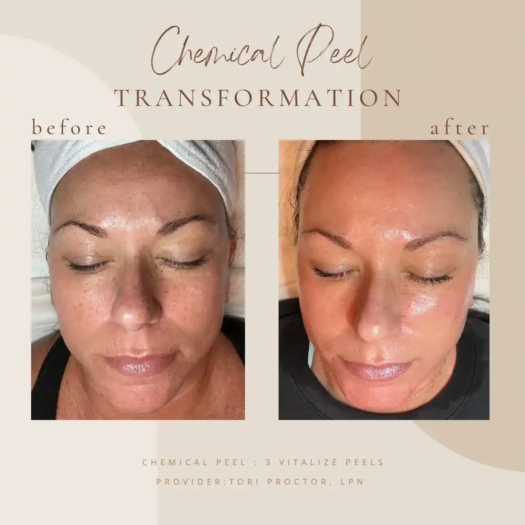 Chemical-Peel-B-A-2in-Clarksville-Tn_11zon