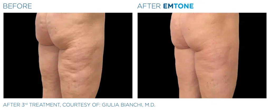 Emtone Treatment in Clarksville TN at Bella Med Spa