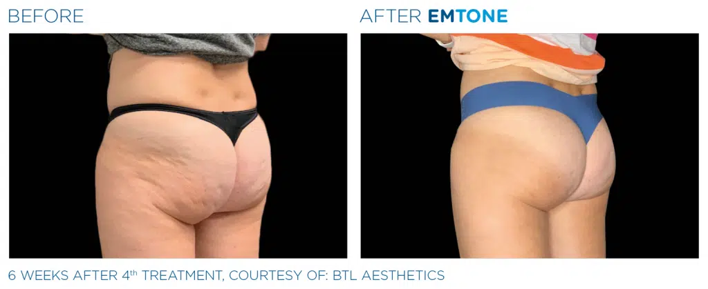 Emtone Treatment in Clarksville TN at Bella Med Spa
