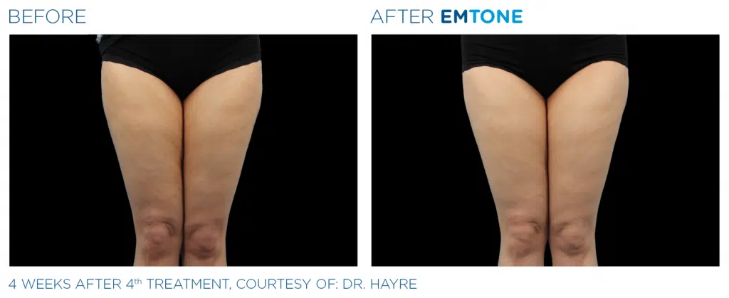 Emtone Treatment in Clarksville TN at Bella Med Spa