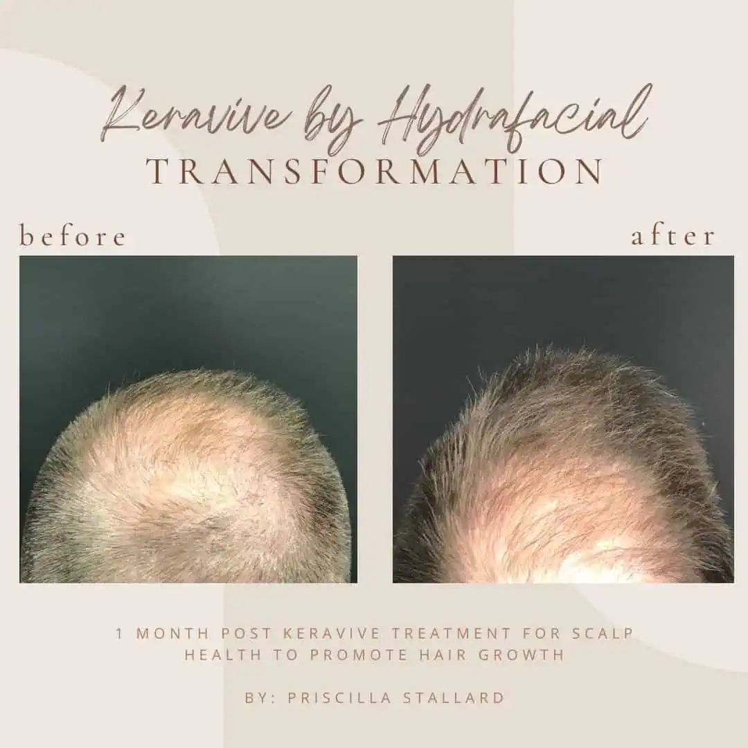 KeraviveScalp Treatment at Bella Medical Spa-A-In Clarksville, TN