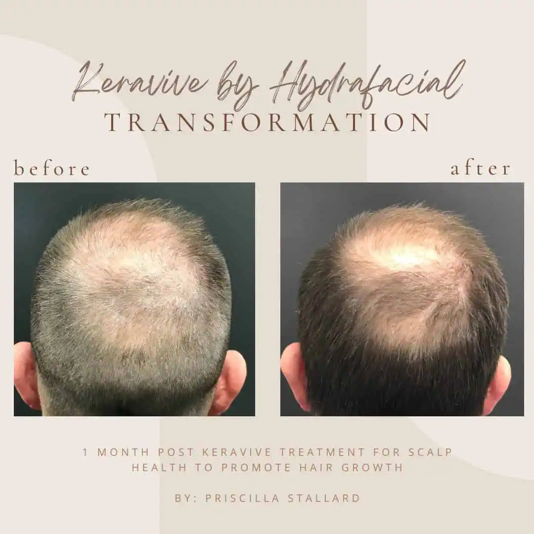KeraviveScalp Treatment at Bella Medical Spa In Clarksville, TN