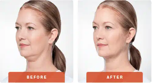 Kybella-Before-After-A-in-Clarksville-Tn