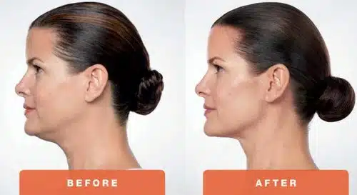 Kybella-Treatment-Before-and-After-Photo-in-Clarksville-Tn