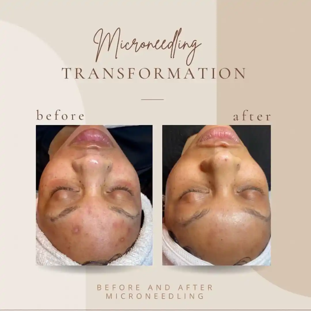 Microneedling treatment before & after Clarksville TN