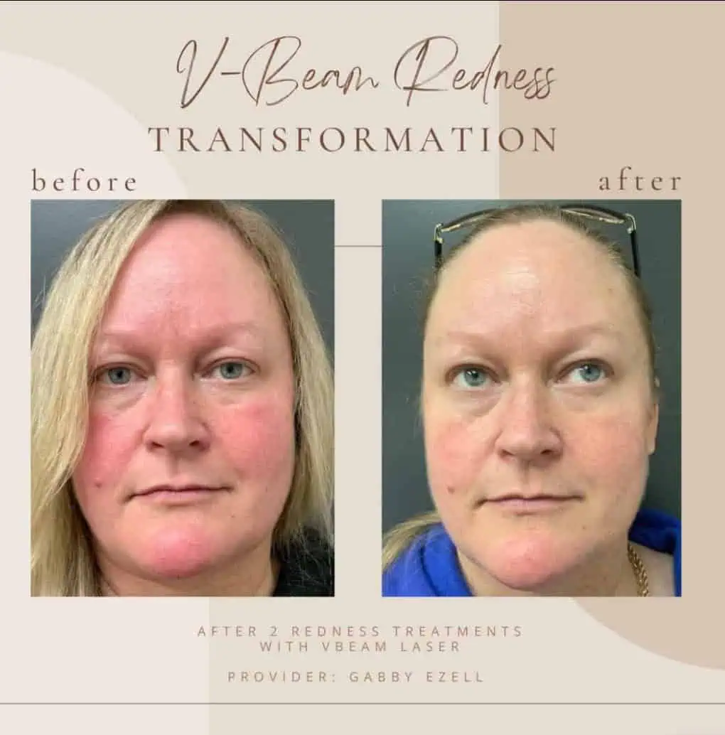 Redness-Rosacea-Treatments-Before-and-after4-in-Clarksville-Tn