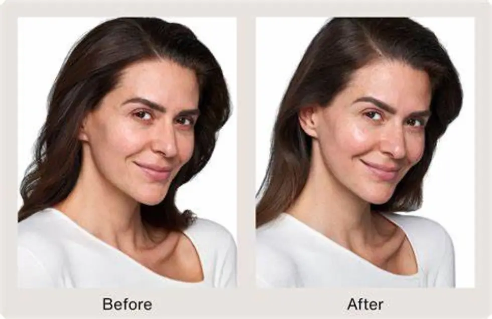 skinvive-before-after-two-In-Clarksville-TN-a--