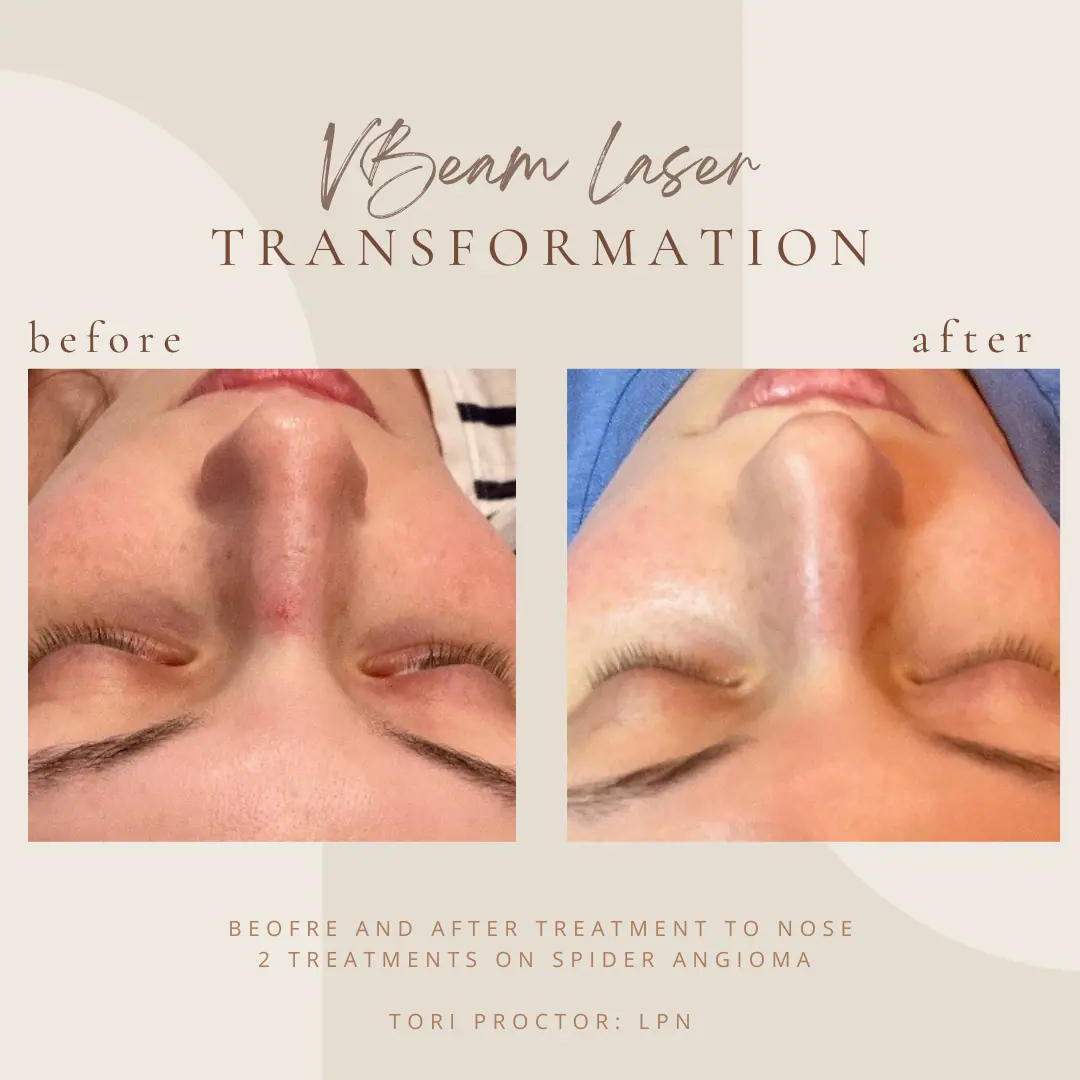 vbeam-laser-A-In Clarksville-TN