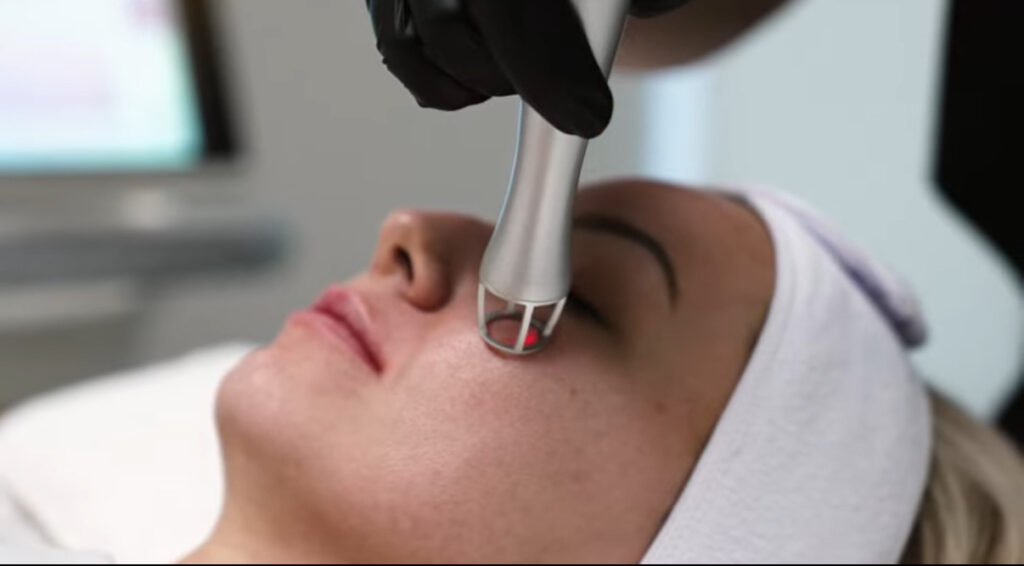 Why CO2RE Laser Is Ideal for Correcting Uneven Skin Tone and Texture