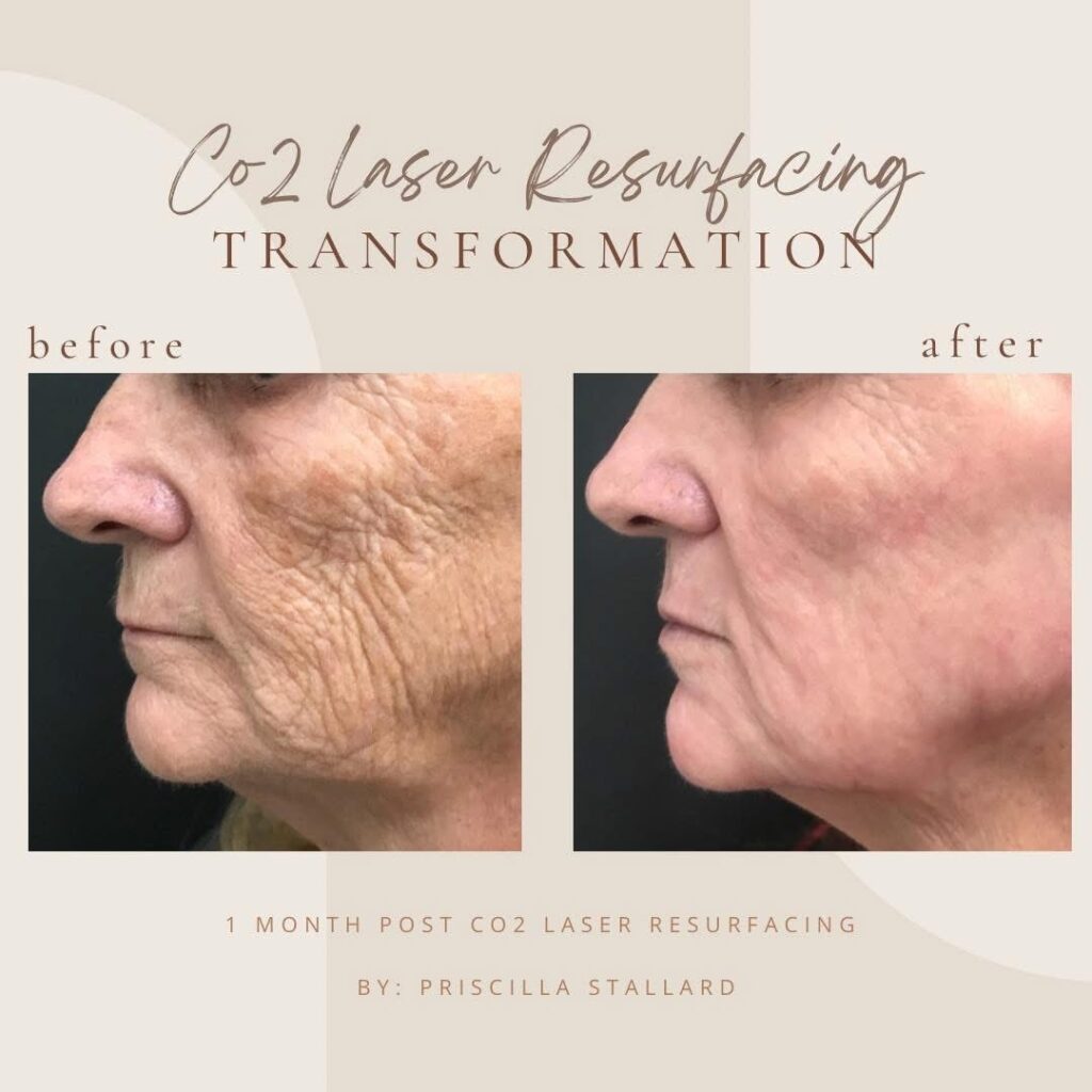 CO2 Laser Resurfacing Transformation