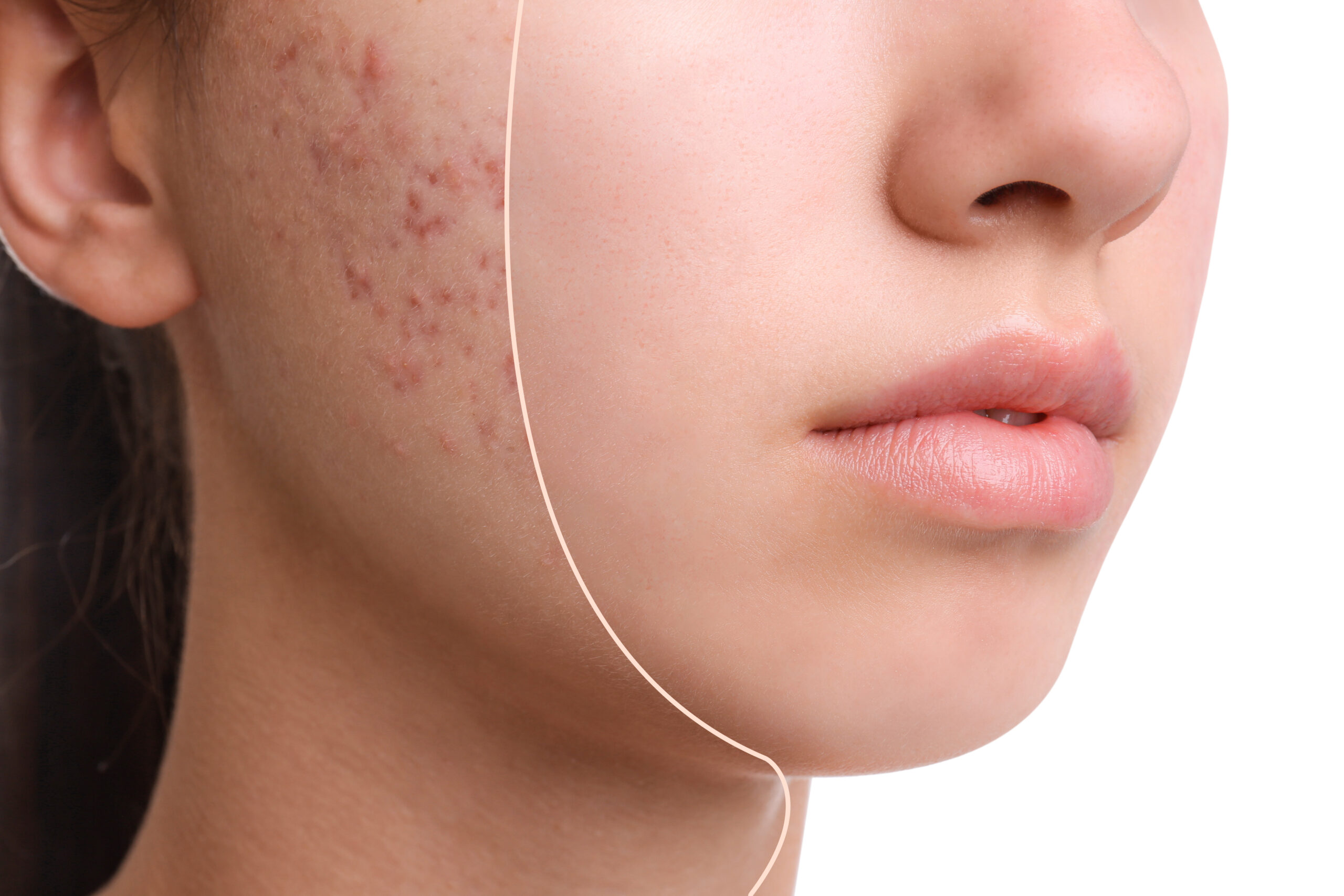 How to Treat Acne and Acne Scars: Professional Treatments That Actually Work