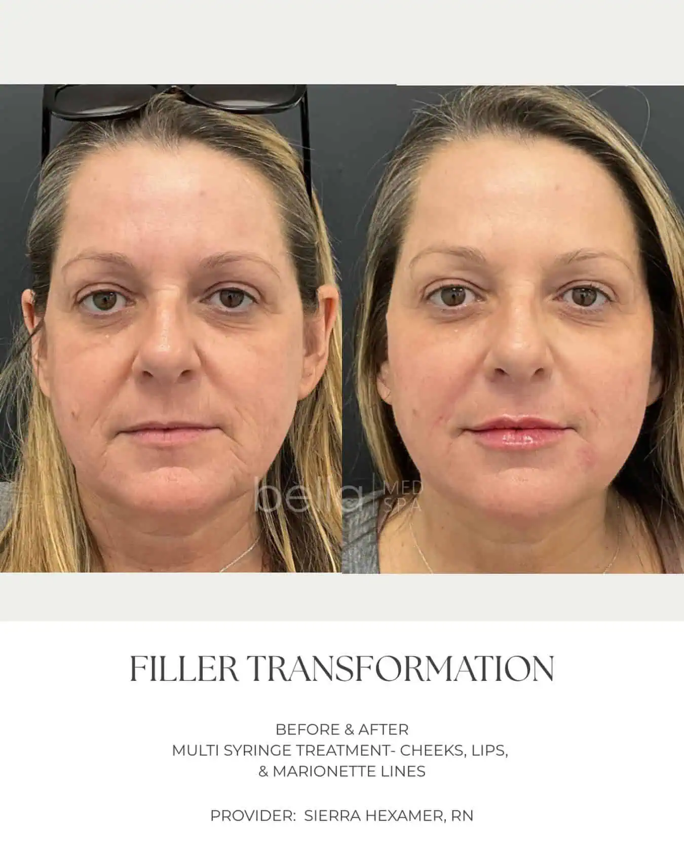 Filler Transformation 1