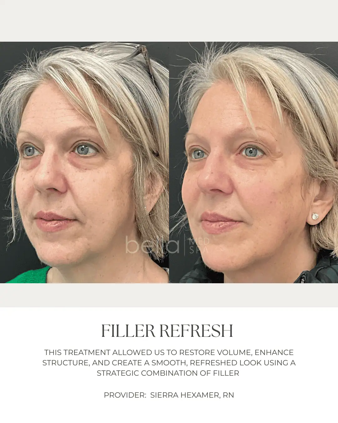 Filler Transformation 2