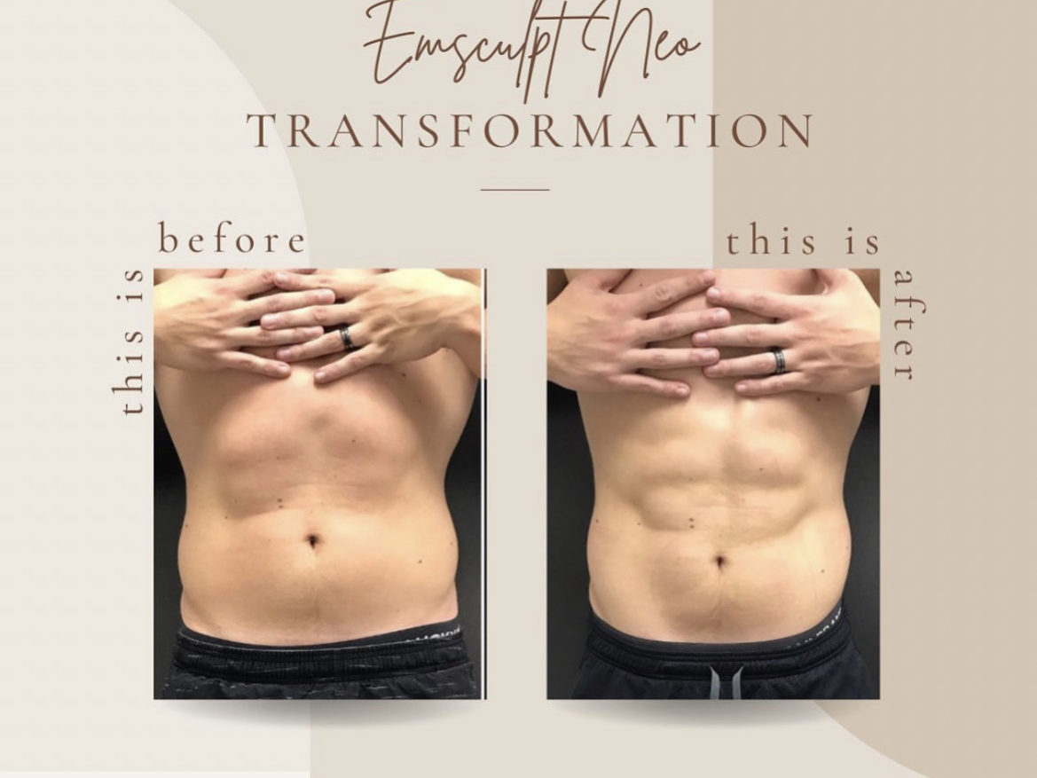Body Sculpting Before And After Treatment | Clarksville, TN | Bella Med Spa